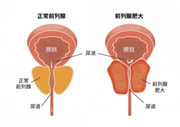 良性前列腺增生，中老年男性“难言之隐”大揭秘